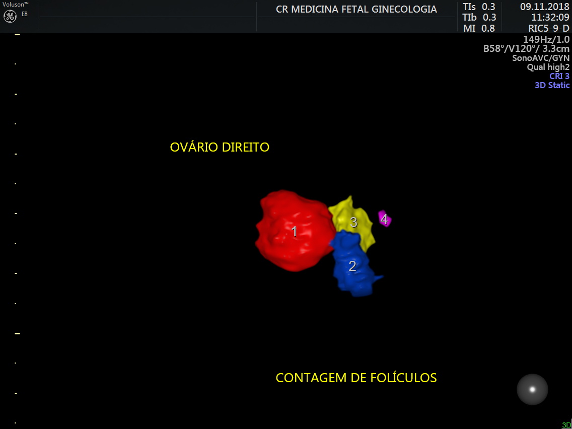 Ultrassonografia Ginecológica 6