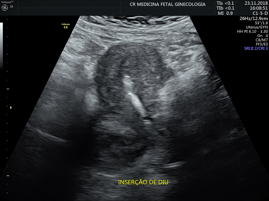 Ultrassonografia Ginecológica 3
