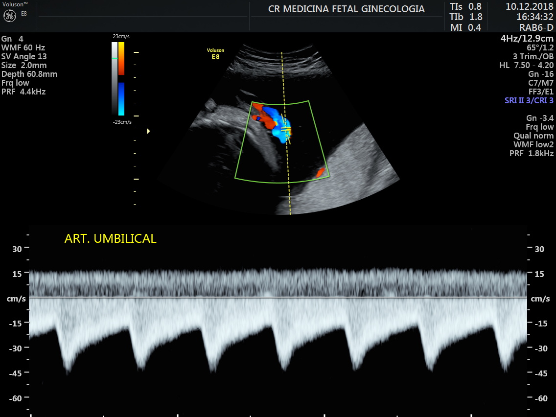 Ultrassonografia Obst Trica Com Dopplerfluxometria Cr Medicina Fetal