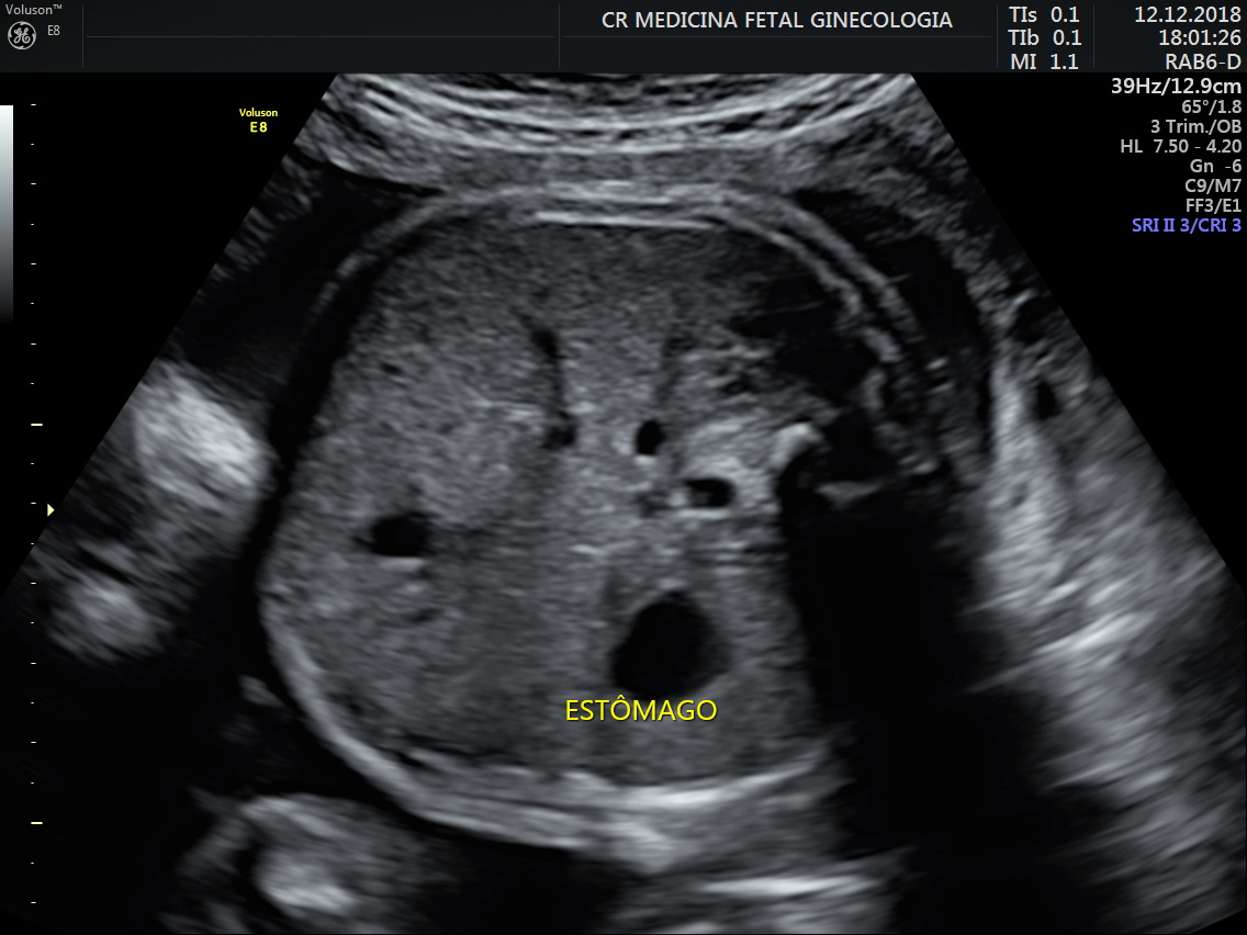 Growth Scan Cr Fetal Medicine 