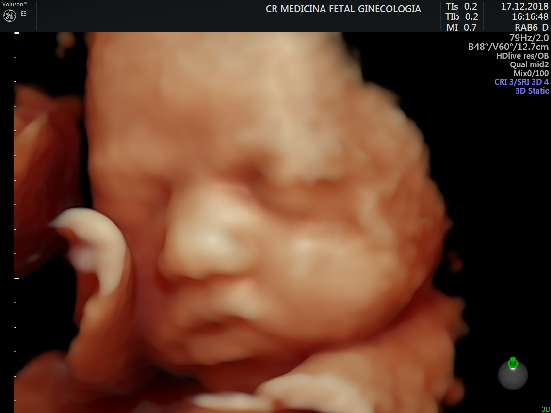 Ultrassom 3d4d Cr Medicina Fetal 